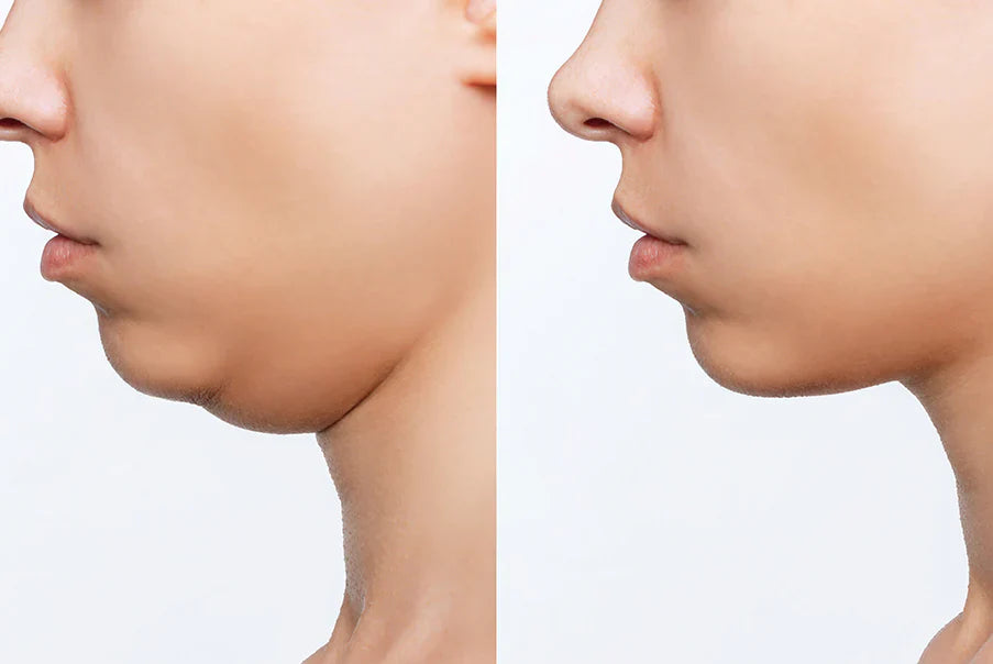 Double Chin, Face Sculpting for V shape