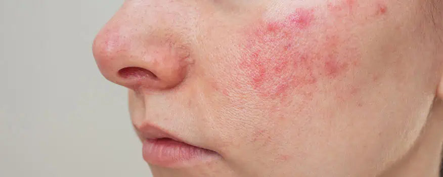 Sensitive and Eczema